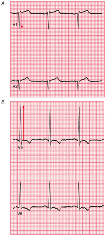 lvh ecg image 1