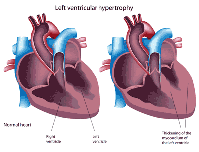 heart with left ventricular hypertrophy