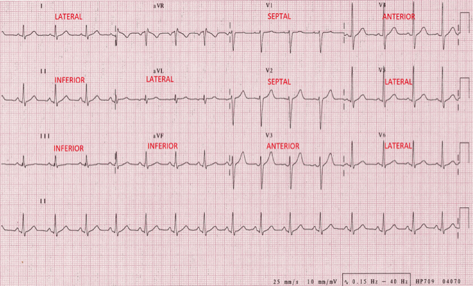 Ischemia Injury Infarction EKG Interpretation | EKG.Academy