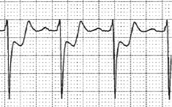 12lead ecg image st segment depression