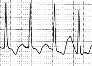 12lead ecg image T wave inversion