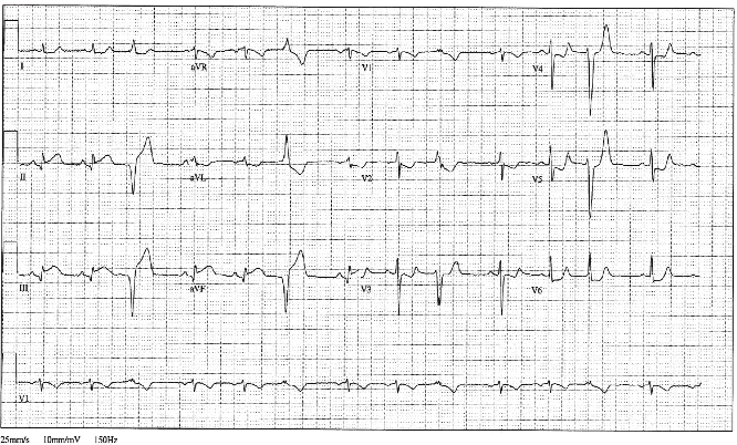 ischemia ecg image 1