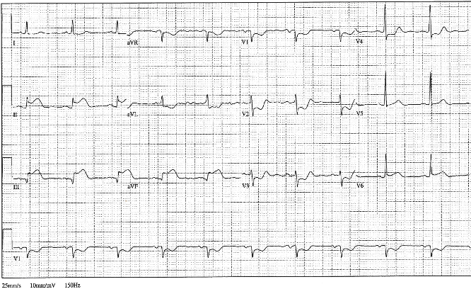 Ischemia Injury Infarction: ECG class, criteria, tracings