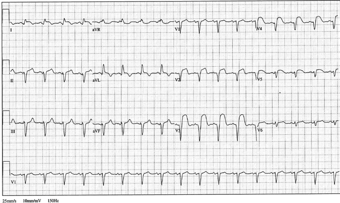 12lead ecg ischemia 11