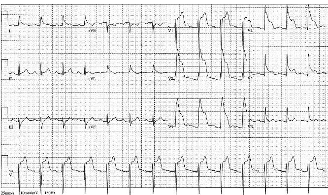 12lead ecg ischemia 12