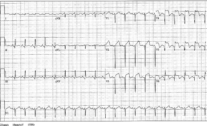 12lead ecg ischemia 13