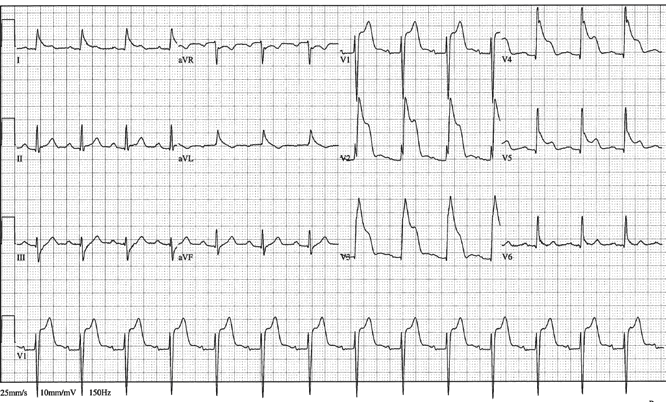 12lead ecg ischemia 14