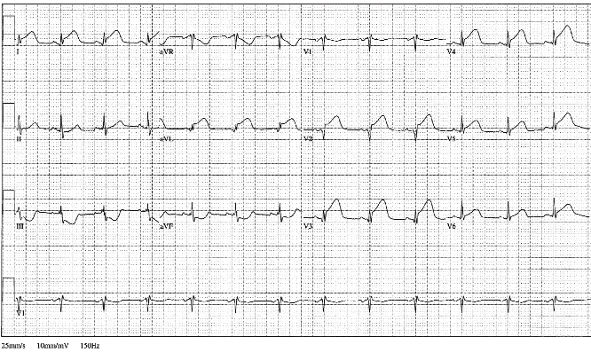 12lead ecg ischemia 15