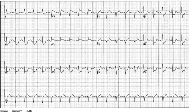 12lead ecg ischemia 16