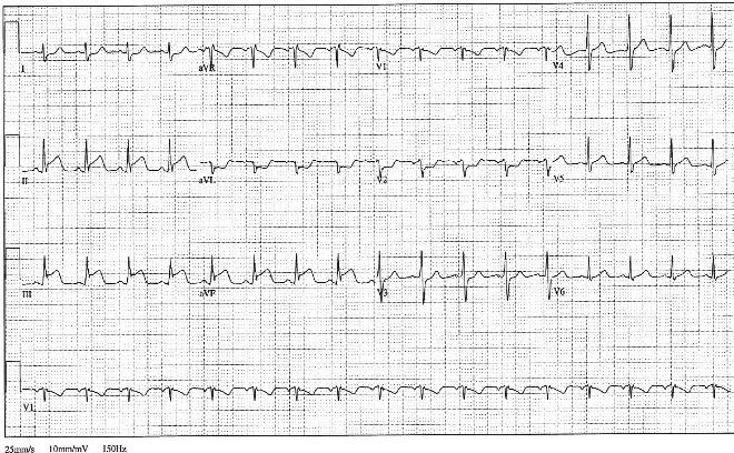 12lead ecg ischemia 7