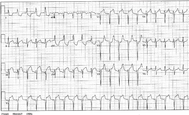 Ischemia Injury Infarction: ECG class, criteria, tracings