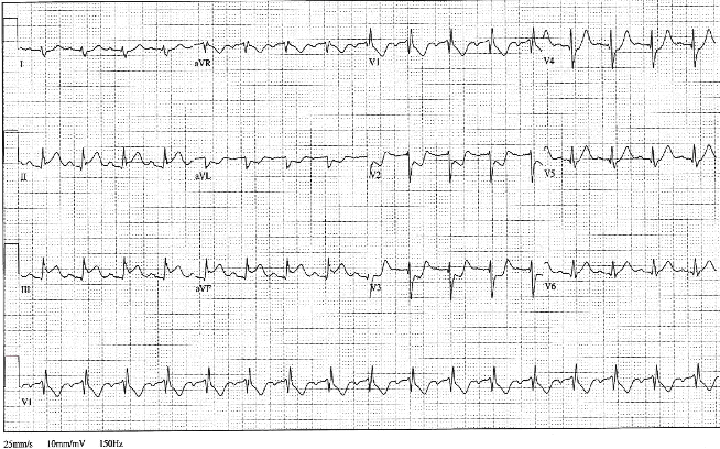 12lead ecg ischemia 9