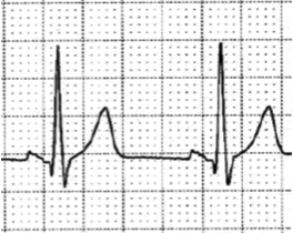 12lead ecg image infarction