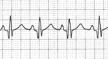 12lead ecg image infarction 2