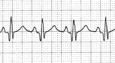 Ischemia Injury Infarction: ECG class, criteria, tracings