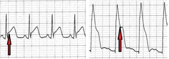 Ischemia Injury Infarction: ECG class, criteria, tracings