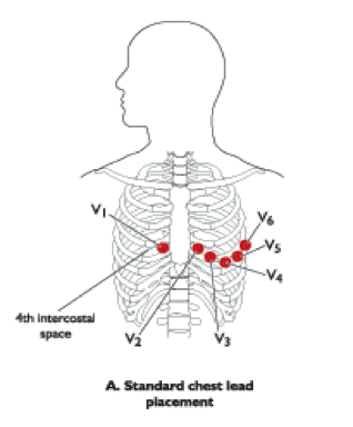 ECG Lead Placement Diagram