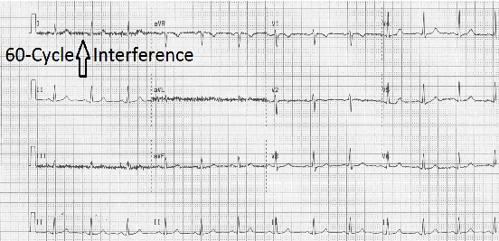 ECG AC Interference