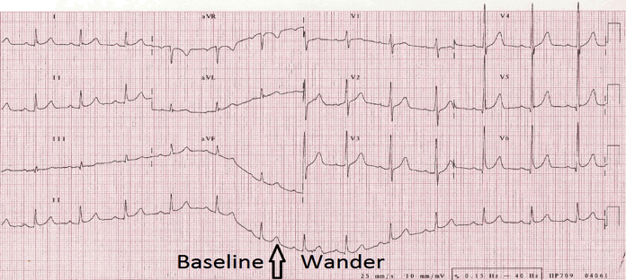 ECG wandering baseline