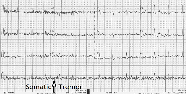 ECG Somatic Tremor