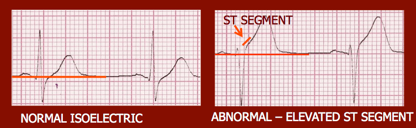 analysis ecg image 103