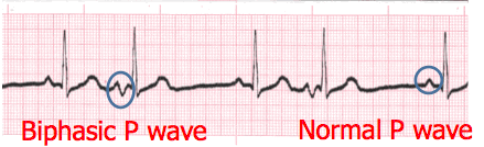 Step 3 P wave Morphology (Shape) ECG Interpretation #318