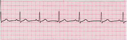 analysis ecg image 111