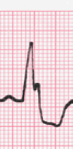 how to measure qrs interval image 118