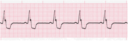 measuing qrs interval image 120