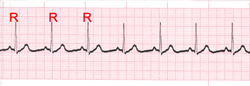 ekg rhythm regularity