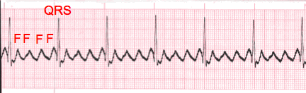 p atrial flutter icd 10