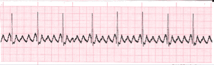 atrial flutter ecg