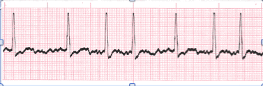 atrial fibrillation tracing