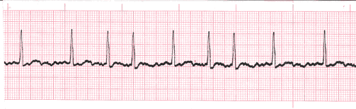 premature atrial contraction strip