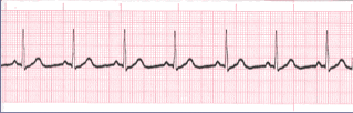 regular ekg rhythm