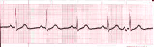 irregular ekg rhythm