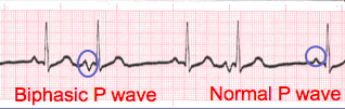 ekg p wave tracing