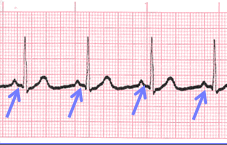 PR interval regular