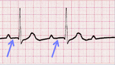 PR interval irregular