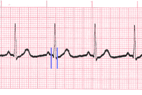 QRS Complex