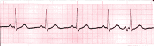 atrial ecg image