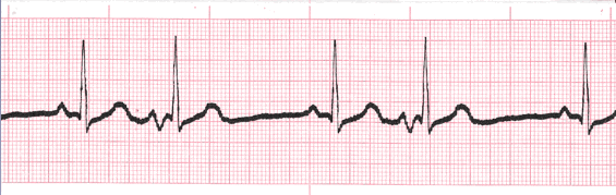 premature atrial contraction strip