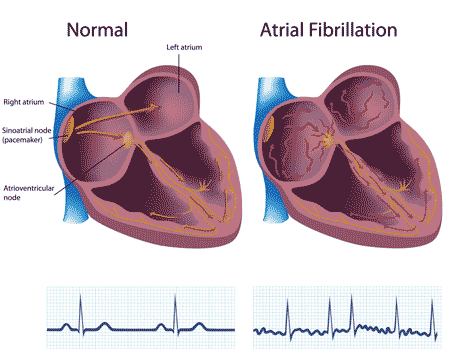 ventricular rhythm heart illustration
