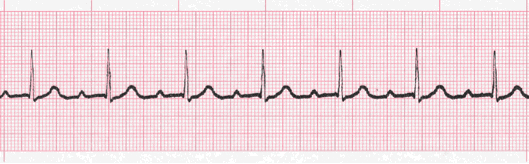 heart block ecg image 102