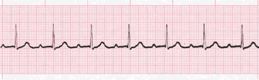 heart block ecg image 103