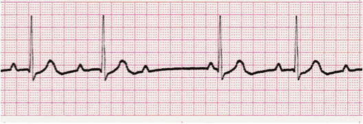 second degree heart block ecg image 104
