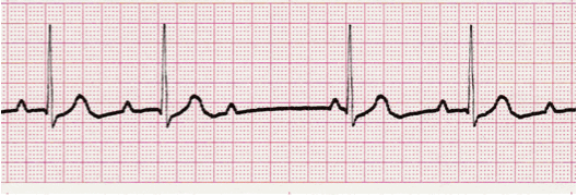 heart-block-rhythms-ecg-course-with-criteria-and-strips-bundle-branch