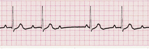 second degree heart block ECG image 105