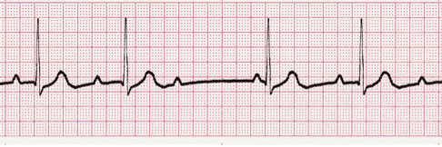 second degree heart block ekg image 105