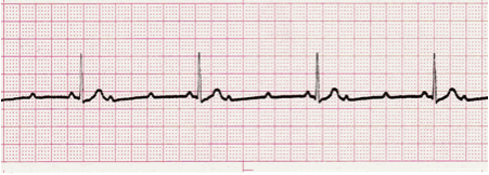 heart block ecg image 106